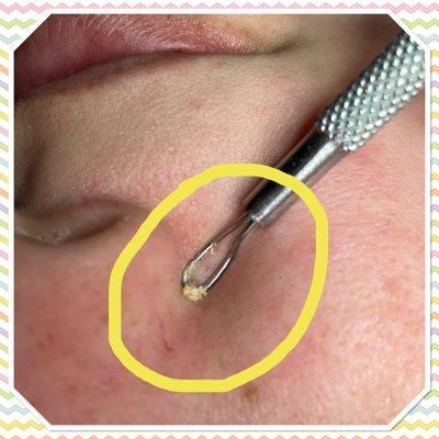 Detailed removal of blackheads & whiteheads