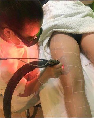 Laser Hair Removal