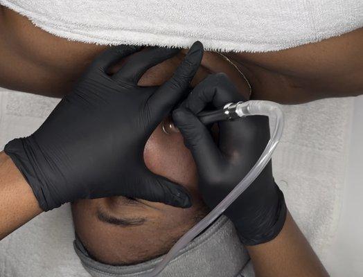 Microdermabrasion