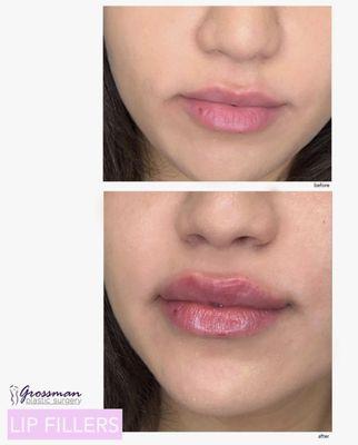 Natural and plump lip fillers by Dr. Peter Grossman, absolutely amazing