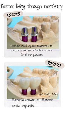 Dental implant crowns milled over custom CAD/CAM titanium abutments