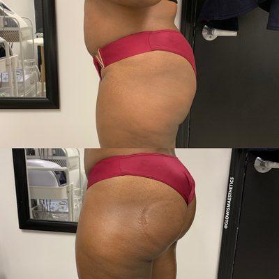 Results from 1 session of the Derrière Butt Lift. We recommend multiple sessions.