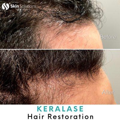 fter just two Keralase Hair Restoration sessions, our patient's hair is showing improvement!