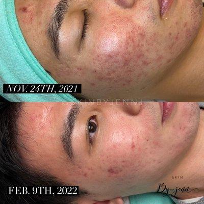 Acne Bootcamp progress.