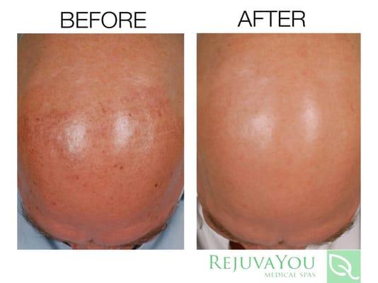 Our treatments rejuvenate the skin, even the top of the head!