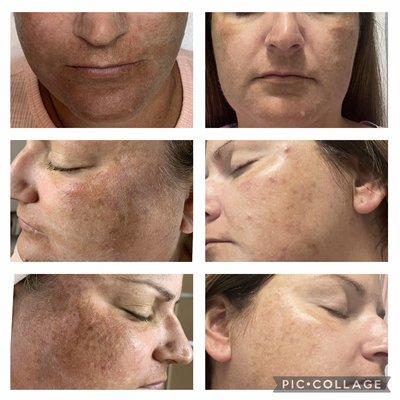 1st chemical peel results to correct hyperpigmentation. She will have 2 more peels to complete the transformation of her skin.