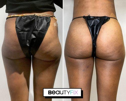 Customized Booty Fix, using FDA-Approved Sculptra we targeted the hollowness above her gluteus maximus to create the curves she desired!