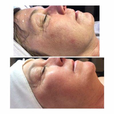 Radiofrequency skin resurfacing with stem cell treatment. Smooth out texture, erase wrinkles, tighten the skin