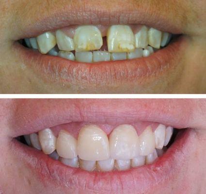 A beautiful new smile after correcting dental spacing and fluorosis. The case was corrected in two visits with four porcelain veneers.