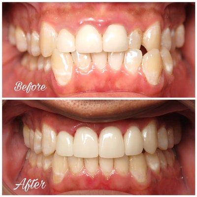 Check out this insane before and after! Invisalign, whitening, crowns, veneers! It's literally a new smile.