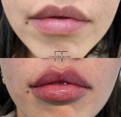 Lip Augmentation by Nurse Fay.