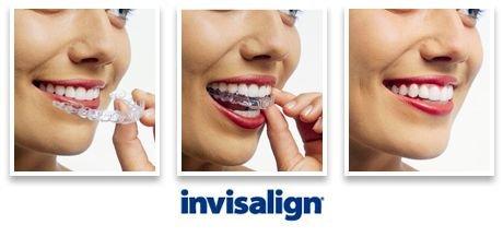 We offer Invisalign to improve your smile :)