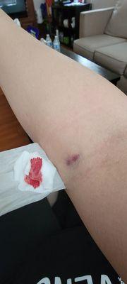 I have never bleed and hurt so much for a blood test ever... even after 2 hours, it still hurt