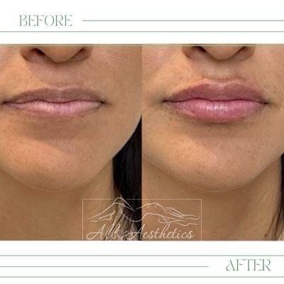 Our beautiful client got Restylane kysse Filler on her lips. It gives her a more natural look and feel compared to other injectables.