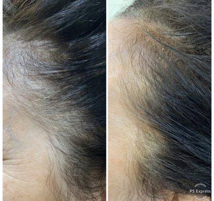 Add density to your hairline with scalp micro pigmentation