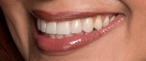 Natural Looking Porcelain Veneers