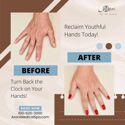 Turn Back Time with Hand Rejuvenation at Azani Medical Spa! 

Are your hands showing signs of aging, such as wrinkles, sunspots, or volume