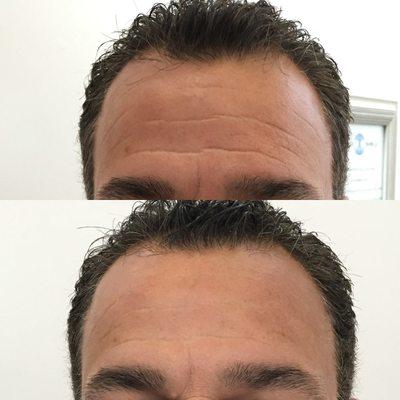 Wrinkle reducing Fresh Face cryofacials