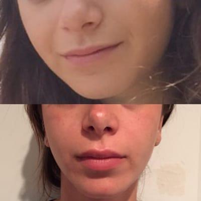 Before & after or Juvaderm fillers- 1 year in