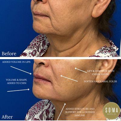 Amazing results! treatment done with Dr. Moran.