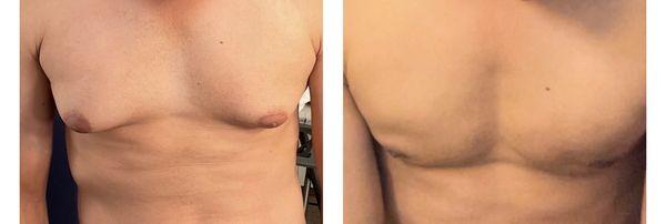 Before and after Gynecomastia procedure