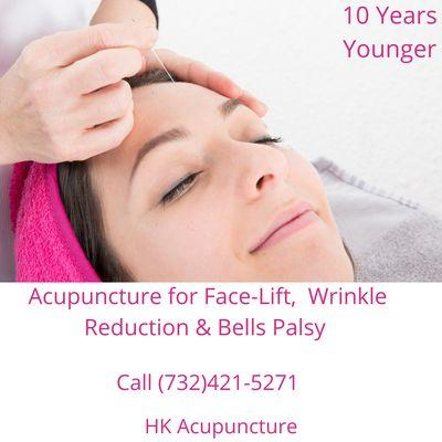 Acupuncture for Younger face & Bells Palsy