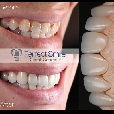 Emax veneers