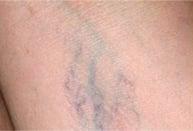 Before-Laser Vein Therapy