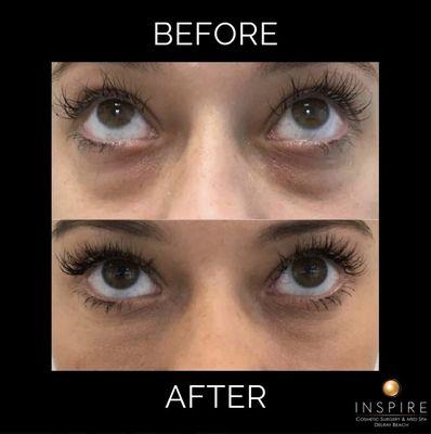 Before and after JUVÉDERM® Dermal Filler to reduce under eye dark circles at Inspire Cosmetic Surgery & Med Spa.