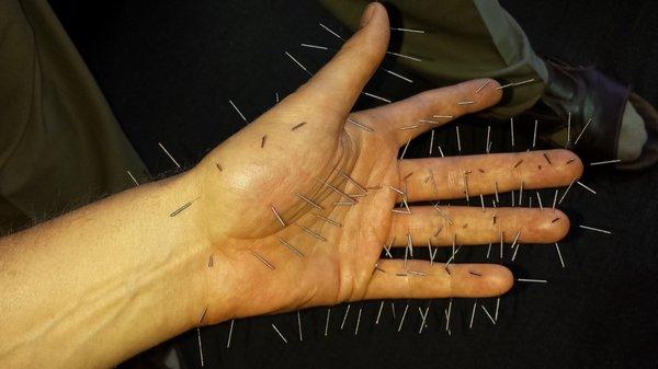 Hand acupuncture