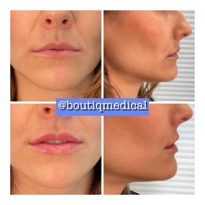 Ooh lala lips, exceptional natural results. Every time