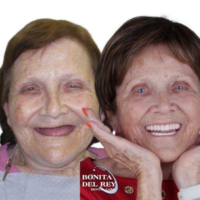 Upper and lower dental implants after missing her teeth for 10 years! She avoided using dentures because of the gag reflex.