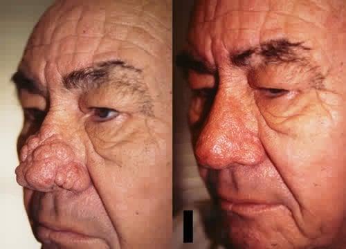 Rhinoplasty