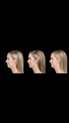 Kybella used to reduce fat under the chin.