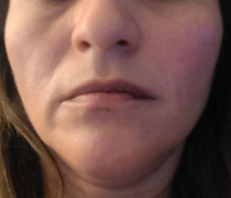 Two weeks after Nasal labial fillers