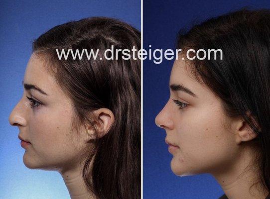 Before and After Rhinoplasty