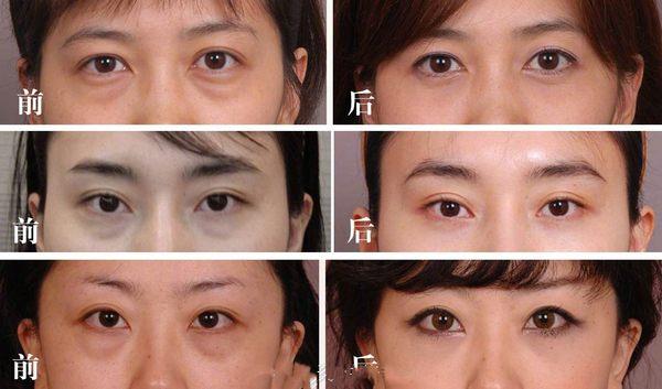 Lower blepharoplasty before and after