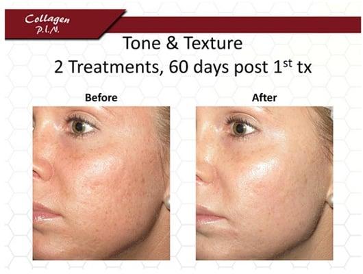 Here is another amazing state-of-the-art skin treatment, the Collagen P.I.N.