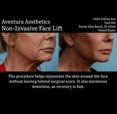 Non Invasive Face Lifting