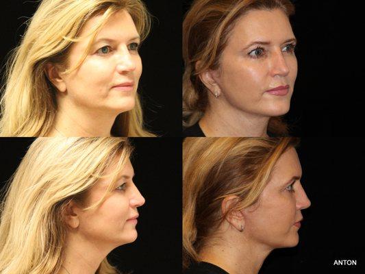 Dr. Anton's patient 2.5 months post op. 51 YEAR OLD WOMAN, 5'8", 160 LBS, UPPER BLEPHAROPLASTY, UPPER EYELID SURGERY