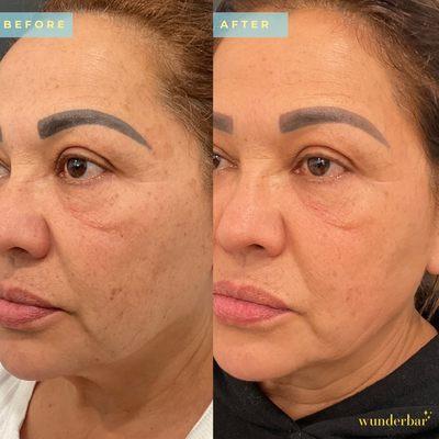 Picoway Laser - Hyperpigmentation