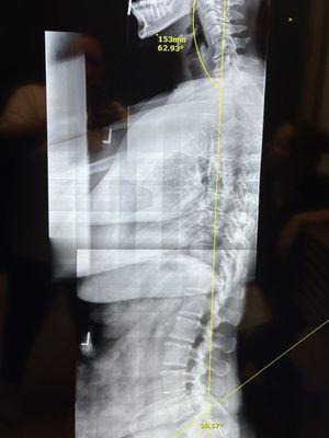 Side spinal view