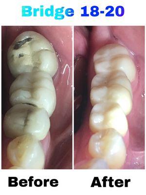 Failing bridge causing food trap and gum irritation replaced with a new functional and beautiful bridge. Another happy patient!