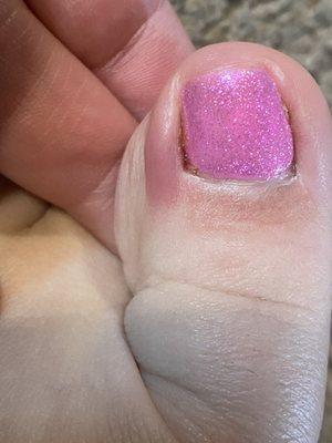 Irritated skin from gel pedicure that is now infected. I can't believe I did not see my toes!