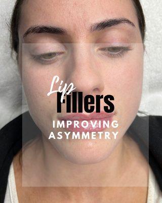 Lip fillers