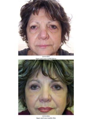 Upper and lower eyelid surgery