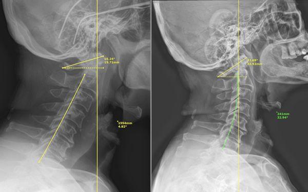 Progress X rays!