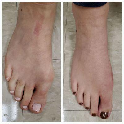 Before and 3 months after bunion correction