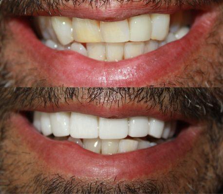 Lumineers changed his smile (top photo).  They instantly whiten, straighten and get you the smile you are looking for (bottom photo).