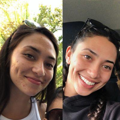 Skin transformation thanks to Peaches Skincare!